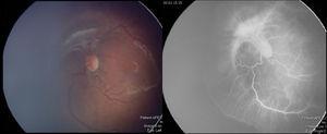 Izquierda: fotografía obtenida con una RetCam II (Clarity Medical Systems, California, EE. UU.) en el ojo de un bebé prematuro, que muestra retinopatía del prematuro estadio 3 en zona i. Derecha: angiografía con fluoresceína del mismo caso, en la que se observa con más claridad la neovascularización en la zona papilar y la línea que demarca la retina vascularizada de la avascular.
