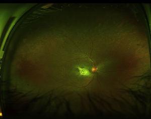 Fotografía de campo ultra-amplio en un ojo derecho obtenida con un Optos Daytona (Optos, Dunfermline, Reino Unido), que muestra un caso de degeneración macular relacionada a la edad con una cicatriz disciforme. Nótense los cambios pigmentarios en la periferia.