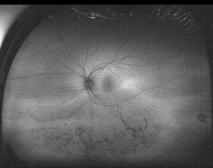 Fotografía de campo ultra-amplio en modalidad de autofluorescencia del mismo ojo mostrado en la figura 5 con diagnóstico de retinitis pigmentosa sectorial, en la que se resaltan las alteraciones pigmentarias en la retina inferior.