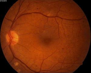 Ejemplo de retinopatía diabética no proliferativa.