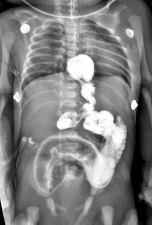 Studiu de contrast care prezintă semne de malricaie intestinală, cum ar fi intestinul vertical mic după ceea ce pare a fi stomacul (intrathoracic) și orb situat în stânga lateral.