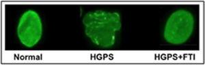 Aspecto del núcleo celular normal (Izquierda), de HGPS (centro) y de HGPS + FTI (derecha) (tomada de Capell, et al., 2005).