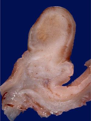 Pólipo fibroide inflamatorio. Vista macroscópica de patología. (Cortesía de la Dra. Fabiola Romano.)