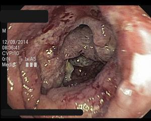 Colonoscopy showed loss of vascular pattern, ulcerations and a nodular mucosa.
