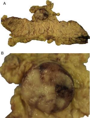 A) Espécimen de pancreatectomía total con lesión de mayor tamaño. B) Acercamiento de lesión sólida de pánceras.