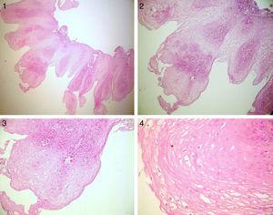 En la imagen 1 y 2, se observa lesión exofítica con tallos fibrovasculares, recubiertos por epitelio escamoso estratificado no queratinizado, hiperplasia de células basales y papilomatosis. En la figura 3, a mayor detalle, datos de papilomatosis e infiltrado inflamatorio crónico leve; por último, en la imagen 4 se aprecian coilocitos.