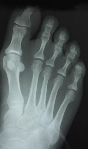Imagen radiológica a los 18 meses de la osteotomía capital. Puede observarse un ligero aumento de partes blandas en el primer espacio interdigital.