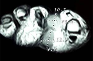 Imagen de RM potenciada en T1 donde se aprecia en el corte axial el aspecto biloculado de la lesión con 2 lobulaciones, una dorsal y otra plantar, separadas por un septo e interconectadas.