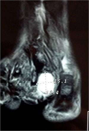 Corte coronal con imagen potenciada en secuencia T2 que permite observar la hiperintensidad del lóbulo dorsal del quiste.