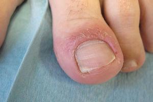 Detalle de las lesiones en el dorso del primer dedo del pie izquierdo.