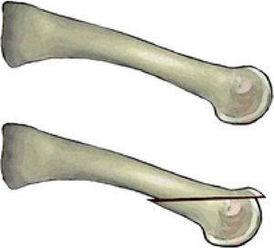 Osteotomía de Weil.