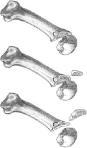 Osteotomía triple de Weil o Weil en tres pasos.