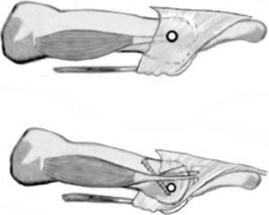 Efecto mecánico de la osteotomía sobre la orientación del eje de la articulación metatarsofalángica con respecto a los tendones interóseos descrito por Trnka et al.18.