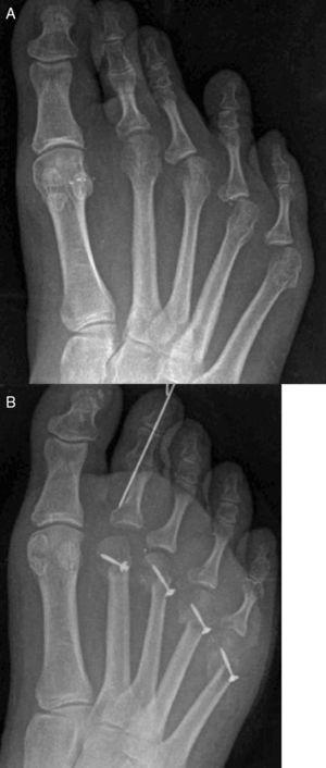 (A and B) Pre- and postoperative X-rays of a case of Weil osteotomies of 2nd to 5th metatarsals with medial translation of the metatarsal head to correct adduction deformity of the digits with a flexor digitorum brevis transposition.51