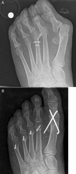 (A) Preoperative view of a patient with a luxation deformity of the second metatarsophalangeal joint. Note the “ms point” as the point of maximum deformity in the base of the phalanx over the metatarsal head. This point is used as a reference of the amount of shortening needed to correct the deformity. (B) From the “ms point” a new metatarsal parabola is constructed.