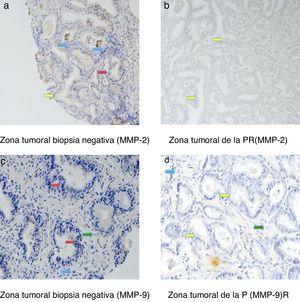 Tinción de la MMP-2 y la MMP-9 en tejido de biopsia negativa y de PR. a) Zona tumoral biopsia negativa (MMP-2). b) Zona tumoral de la PR (MMP-2). c) Zona tumoral biopsia negativa (MMP-9). d) Zona tumoral de la PR (MMP-9).