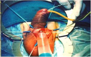 Perforación de uretra distal durante la dilatación.