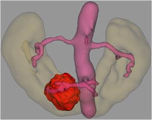 Caso 2: Reconstrucción 3D de la anatomía del tumor en herradura demostrando presencia de tercer tronco arterial con ramas para el istmo renal y el tumor.