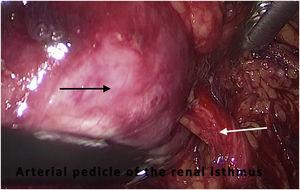 Caso 2: Imagen intraoperatoria de pedículo vascular a nivel del istmo (flecha blanca) que irriga tumor renal (flecha negra).