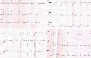 Electrocardiograma registrado durante el primer contacto médico.