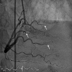 Angiografía coronaria que muestra embolias múltiples con oclusión de ramas distales de arteria coronaria derecha (flechas).