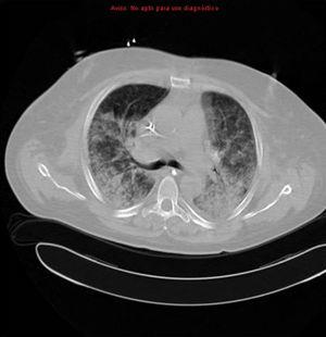Tomografía computarizada torácica con presencia de condensaciones y áreas de aumento de la atenuación pulmonar en vidrio deslustrado bilateral.