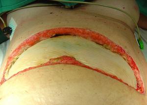Laparotomía subcostal bilateral y cierre abdominal temporal con malla de PTFEe.