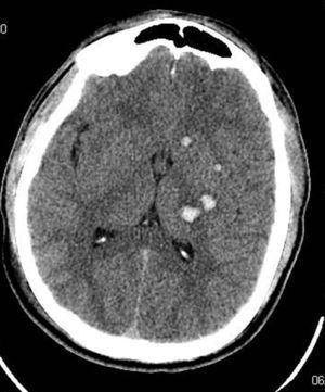 Imagen de tomografía axial computarizada craneal que muestra hemorragia intraparenquimatosa en ganglios basales izquierdos.