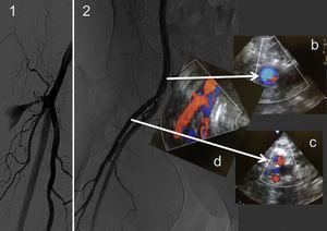 Composición de imágenes radiológicas de arteria femoral profunda con sangrado activo (1), tras colocación de stent cubierto (2), imágenes de Doppler color (b, c y d). Se aprecia zona de sangrado con 2 vasos (c) en eje corto y en eje largo (d). En la zona de punción correcta se identifica un vaso (b y d).
