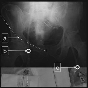 Composición fotográfica con extremos proximales de catéteres femorales para TDE y radiografía de pelvis del mismo paciente. Catéter izquierdo insertado con referencia en pliegue inguinal (c) con luz aferente en ilíaca externa. Catéter derecho con referencia ecográfica y en ligamento inguinal imaginario (a) (palpando espina ilíaca anterosuperior y sínfisis del pubis). La punción en vaso (b) es la correcta y está situada encima de la cabeza del fémur. La luz aferente alcanza zona más central.