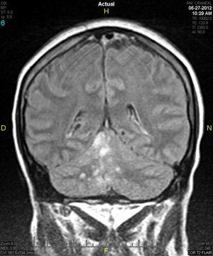 Lesiones parenquimatosas tipo nodular en secuencia T2 Flair en territorio de la cerebelosa superior derecha en RMN.