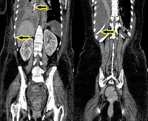 CT reconstrucción coronal: sonda nasogástrica en el interior del bronquio principal derecho, sale por la pleura derecha hacia el exterior produciendo un hidroneumotórax.