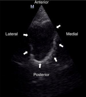 Right maxillary sinus ultrasound, phased-array probe, demonstrating a well-defined hyperechoic walls of the right maxillary sinus (arrows). This sign is denominated “complete sinusogram”.