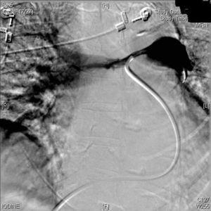 Arteriografía pulmonar que muestra defecto de perfusión de tronco y arteria pulmonar izquierda y del 50% de la derecha.