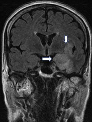 Área de hiperintensidad de señal subcortical en lóbulo temporal izquierdo que incluye a la ínsula y es más marcado a nivel de hipocampo, con moderado efecto masa por edema y realce tras administración de gadolinio.