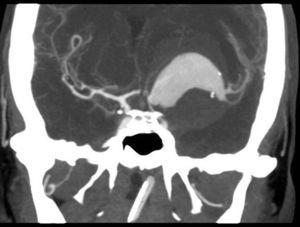 Imagen angiográfica del aneurisma gigante de la arteria cerebral media izquierda rodeado de hematoma.