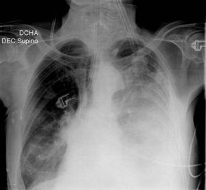 Radiografía de tórax mostrando derrame pleural izquierdo y probable atelectasia pulmonar compresiva.