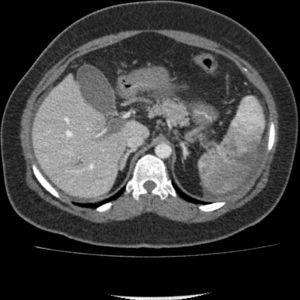Angio-TC abdominal que muestra trombosis venosa portal e infarto esplénico. Imagen inicial realizada en la puerta de urgencias.