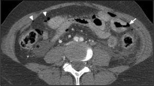 TC de abdomen en el que se observa líquido peritoneal (asterisco), neumoperitoneo (puntas de flecha) y foco de perforación intestinal (flecha) de un asa intestinal de pared engrosada.