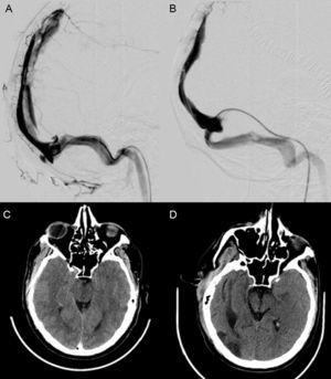 A) Flebografía que muestra defecto de repleción en el seno longitudinal superior. B) Flebografía con ausencia de defectos de repleción en su interior, con adecuado drenaje a través del seno transverso izquierdo. C) TC craneal: signos de hipertensión intracraneal (borramiento de surcos de la convexidad bilateral, disminución del tamaño de las cisternas basales, aumento del eje anteroposterior del mesencéfalo). D) TC craneal al alta con mejoría de los signos indirectos de hipertensión intracraneal.