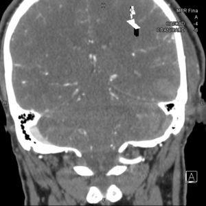 TC reconstruido en coronal: trombosis postraumática del seno transverso izquierdo.