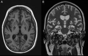 Secuelas de encefalopatía postanóxica. Imágenes de RM potenciadas en T1 en el plano axial (A), y en T2 en el plano coronal (B), que muestran áreas de encefalomalacia postisquémica con afectación selectiva del globo pálido bilateral, como secuela del daño hipóxico-isquémico severo.