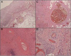 Histopatología: cristales de colesterol en el interior de la luz de las pequeñas arteriolas. A) Gástrico. B) Esplénico. C) Páncreas. D) Piel (tinción hematoxilina-eosina, ×10).