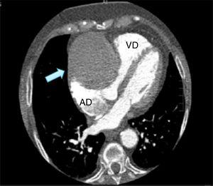 Angio-TAC, la imagen muestra el aneurisma de la coronaria derecha comprimiendo las cavidades cardiacas derechas. AD: aurícula derecha; VD: ventrículo derecho.