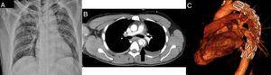 A) Radiografía de tórax al ingreso en la que no se objetivan alteraciones significativas. B) Con la flecha se muestra la lesión de aorta torácica descendente incompleta con seudoaneurisma, previamente al procedimiento endovascular. C) Prótesis endovascular correctamente posicionada.
