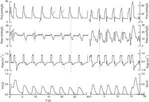 Record di pressione nelle vie aeree, pressione esofagea, flusso e volume, in Volume controllato ventilazione assistita in 2 pazienti ( sinistra e destra). Pressione sulle vie aeree L'inizio dell'ispirazione è passivo, non vi è alcuna goccia di pressione che indica lo sforzo respiratorio (←). Durante la fase di pausa inspiratoria, la morfologia e l'ampiezza cambia da cicli agli altri (←). Il flusso inspiratorio è costante, il flusso espiratorio ha oscillazioni all'inizio della scadenza meccanica, che di solito riflettono gli sforzi inspiratorici (←). La pressione esofagea riflette un aumento della pressione intratharacica all'inizio dell'ispirazione meccanica seguita da una successiva diminuzione, che riflette lo sforzo del paziente (linea discontinua). La relazione tra il ciclo meccanico e lo sforzo è 1/1 in un caso e variabile nell'altro (1/1 nel 90% del record totale, coesistente con 1/3 e 1/2). Il divario era di 60 e 47ms o 21 e 14 ° (θ = Tin-TIM / TTOTM · 360). Il tempo inspiratorio dello sforzo muscolare è di 0,8-0,9 e quando produce un aumento del doppio colpo a 1,4s. La pressione di occlusione nel primo 100ms (P01) era 3,9 e 8,2 cmh2o nei cicli a doppio trigger in un caso e 4,5 e 8,5 cmh2o rispettivamente nel secondo caso. I parametri relativi allo sforzo inspiratorio: delta pressione esofagea (Δpes) 11cmh2o, il tempo di pressione integrale (IPT) 1.6 ± 0,3 e 2,5 cmH2o · S, il primo paziente non aveva esaurito l'effusione pleurica, quindi misuriamo la conformità della scatola toracica Durante la ventilazione meccanica controllata (160 ml / cmh2o) e calcolato il tempo di pressione del prodotto9 (area ombreggiata), considerando la pressione elastica del supporto del muro toracico, in questo caso la stima dello sforzo respiratorio è 5, 6cmh2o · s (96,2 cmh2o · s / M) e in stress con doppio trigger di 12,5ch2o · s. Nel secondo caso: ΔPES 16CMH2O, IPT 2.5CMH2O · S (54 cmh2o · s / m) e in cicli a doppio trigger di 17 cmh2o · s (370cmh2o · s / m).