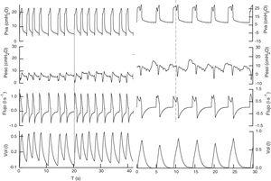 Registrazione dei segnali (PVA, PES, flusso, vol) sotto il supporto della pressione dei 2 pazienti. Nel primo di 18 con 5CMH2O peep, migliorando l'interazione con il respiratore, lo sforzo precede il ciclo meccanico (linea continua), con un tasso respiratorio di 22RPM, esegue un volume corrente di 0,450 l, senza segni di eccessivo sforzo respiratori e con Un delta di pressione esofagea inferiore a 5cmh2o. Nel secondo caso con pressione di supporto di 25 e PEEP 6, mantiene un tasso respiratorio di 12RPM e un volume corrente di 0,783L. In questo lo sforzo del paziente è dopo l'inizio del ciclo meccanico, il trigger del respiratore è probabilmente il cambiamento di pressione (o flusso) causato dal battito cardiaco. Lo sforzo del paziente (linea discontinua) produce una diminuzione della fase di plateau della pressione delle vie aeree, che provoca un reaver di flusso inspiratorio.