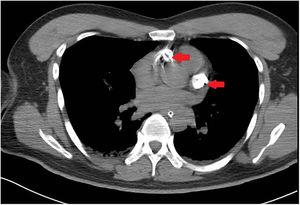 Transverse chest CT image. Red arrows indicate locations of high-density shadows.