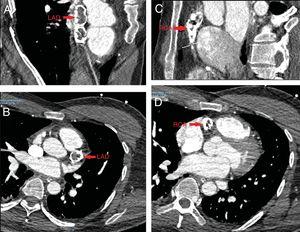 Transverse (B, D) and parasagittal (A, C) CTA images. Ectatic left anterior descending coronary artery (LAD; red arrows in A and B) and right coronary artery (RCA; red arrows in C and D) with intraluminal calcification.