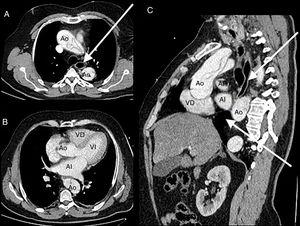 TC toracoabdominal. A. Imagen axial preestenótica, donde se observa dilatación esofágica y disección aórtica. B. Imagen axial de la zona de compresión (asterisco blanco). C. Imagen coronal que demuestra afilamiento esofágico progresivo. AI: aurícula izquierda; Ao: aorta con imagen de flap aórtico; AP: arteria pulmonar; VD: ventrículo derecho; VI: ventrículo izquierdo. Flecha blanca: dilatación esofágica pre y postestenosis. Asterisco blanco: zona de obstrucción esofágica.